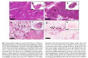 医疗科研新发现 | 菁易科研解读囊性纤维化胰腺病理变化研究