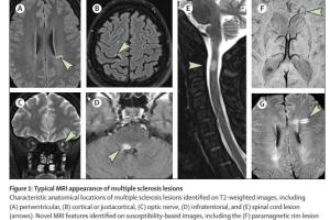 医疗科研新进展 | 菁易科研解读：2024 年麦克唐纳标准如何革新多发性硬化症诊断？
