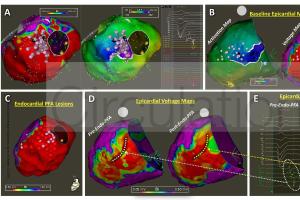 医疗科研新突破｜菁易科研解读高电压PFA导管治疗室性心律失常研究