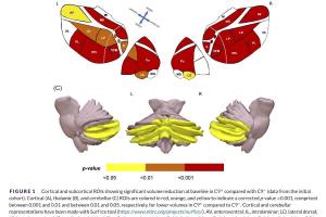 医疗科研新发现！菁易科研解读C9orf72基因突变携带者脑部变化量化研究