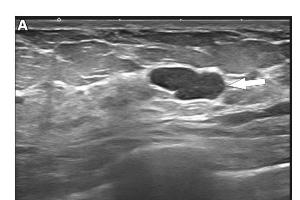 医疗科研新动态 | 菁易科研解析乳腺超声在乳腺疾病诊疗中的前沿进展