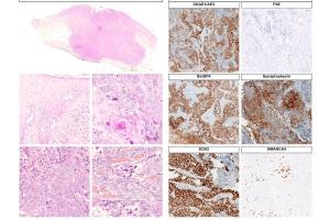 医疗科研新发现 | 菁易科研解读原发性皮肤SWI/SNF缺失肿瘤特征