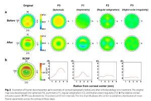 医疗科研新发现 | 菁易科研解析非球面角膜塑形镜与近视控制的关联