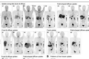 医疗科研新发现 | 菁易科研解读68Ga - FAPI - 46 PET/CT在胆管疾病中的应用