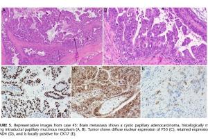医疗科研新发现 | 菁易科研解析胰腺导管腺癌脑转移临床病理特征