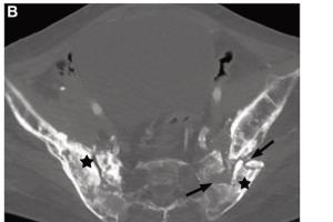 医疗科研新洞察 | 菁易科研解读放射与免疫治疗的肌肉骨骼并发症