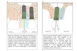  医疗科研新发现 | 菁易科研解读：局部因素如何影响种植体周围炎发生？