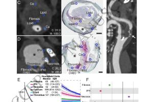 医疗科研新进展 | 菁易科研解读：光子计数CT检测颈动脉斑块特征潜力大