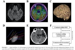医疗科研新突破 | 菁易科研解读：有效连接如何预测颞叶癫痫手术效果？