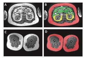 医疗科研新发现 | 菁易科研解读：减重手术中脂肪分布对骨代谢的影响