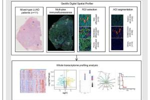 医疗科研新发现 | 菁易科研解读早期肺腺癌组织学亚型分子奥秘
