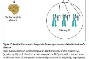  医疗科研新发现 | 菁易科研解读唐氏综合征与阿尔茨海默病关联