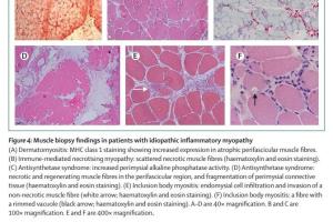 医疗科研新进展 | 菁易科研带你了解特发性炎症性肌病分类与管理