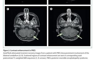 医疗科研新进展 | 菁易科研解读：可逆性后部脑病综合征诊断与治疗突破